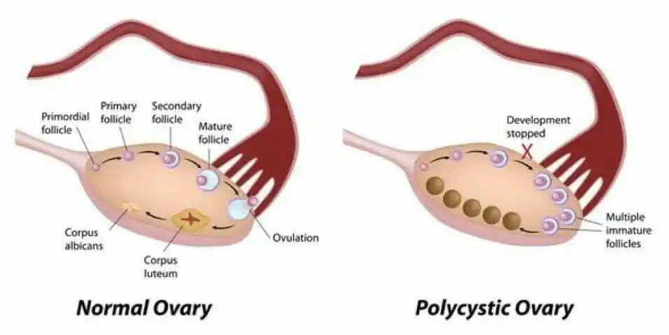 Image from QURAN معلومات طبية ونصائح عامه 🤍: ‏🚺 تكيـس المبـايض (PCOS) polycystic ovary syndrome  هو اضطراب هرموني ...