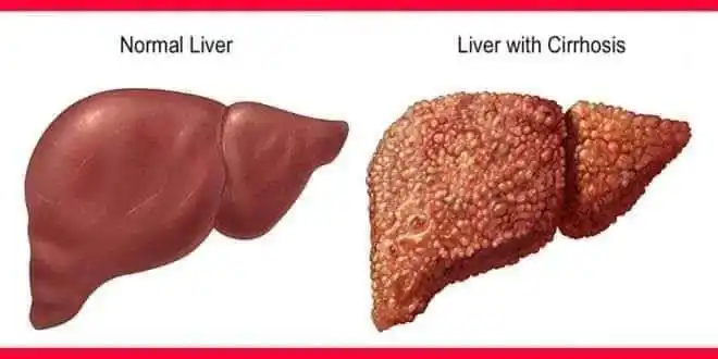 Image from QURAN معلومات طبية ونصائح عامه 🤍: 🎈تشمع الكبد cirrhosis  من الأمراض الشائعة   🔎هو عبارة عن تبدل النسيج...