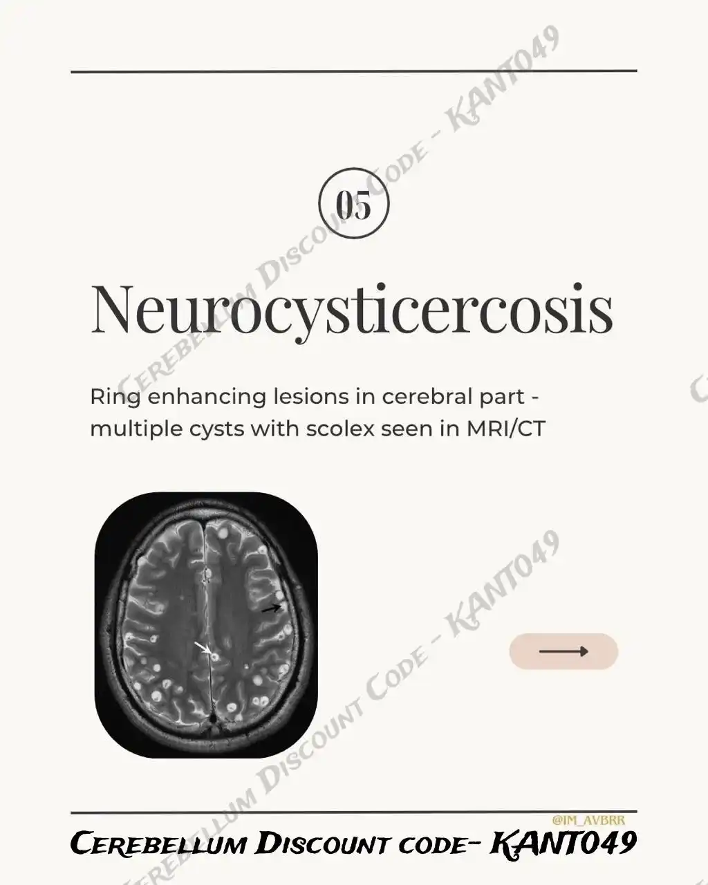 Image from 2.0 🇧 🇹 ( Flashcards) ✅™© / NEET/ INICET/ FMGE: INICET 2025...
