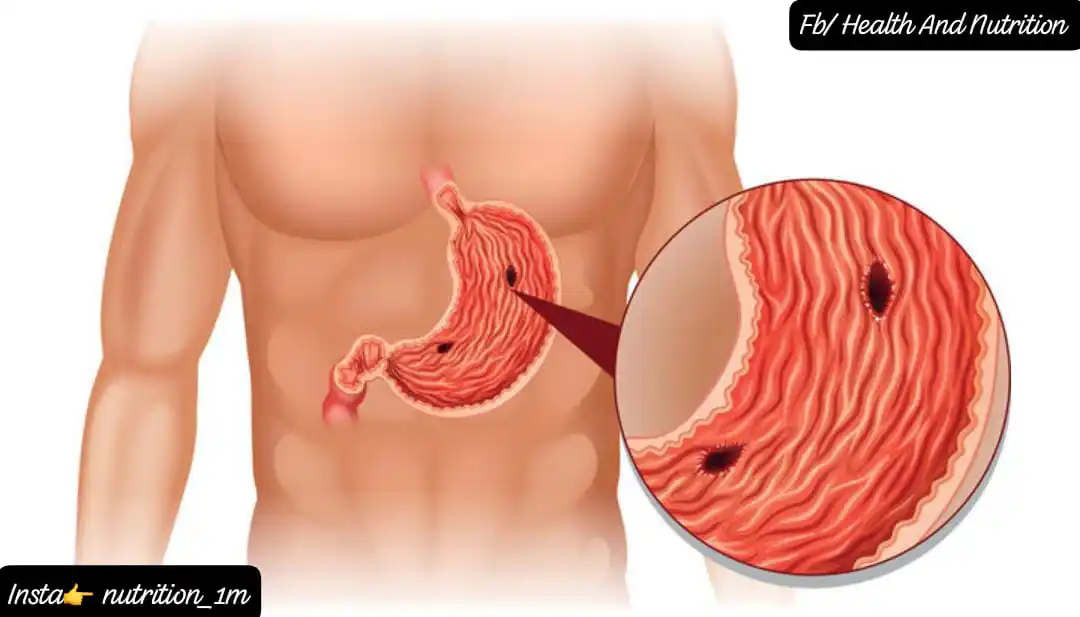 Image from Health And Nutrition: A Patient today: “I have ulcer, so I eat biscuit and tea.”  You’re not...
