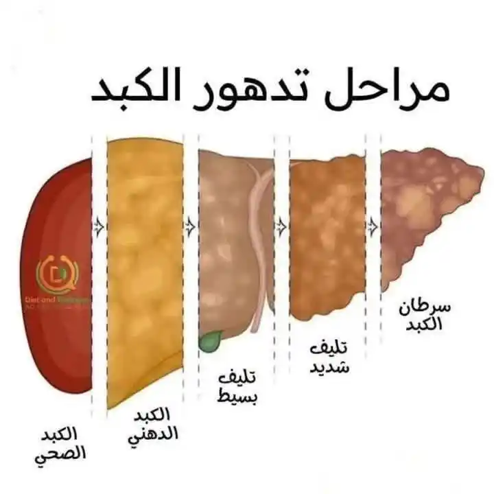 Image from قناة البدر مخصصة للاهتمام بالصحة والرياضة،: الكبد يشتكي وأنت لا تدري📌 هل تشعر بالتعب الدائم؟ انتفاخ في البطن؟ نو...