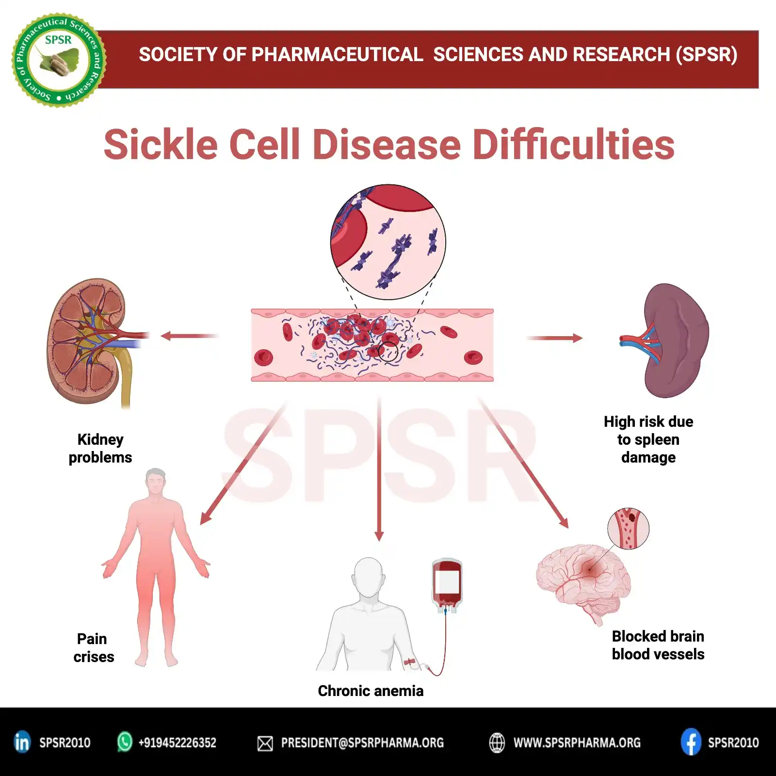 Image from INTERNATIONAL JOURNAL OF PHARMACEUTICAL SCIENCES AND RESEARCH: 🩸 19th June World Sickle Cell Day | Hope through Herbal Innovation 🌿...
