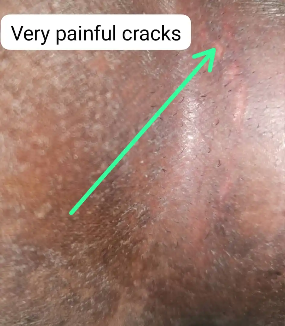 Image from Mindset: 3. Cracked or Oozing Stage:  - If you keep scratching or leave it untr...