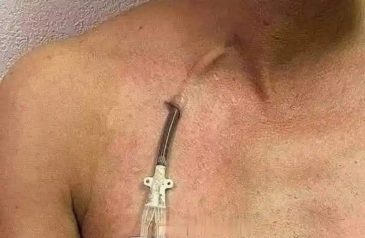 Image from رب سے جڑنے کا سفر: ڈائلاسس(Dialysis) کے دوران جسم سے خون سرخ نالی سے باہر نکالا جاتا ہے ،...