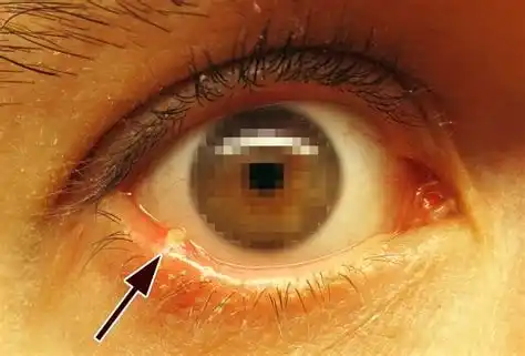 Image from Silberwasser KS: Erfahrungsbericht Gestern morgen juckte das Auge sehr und ich sah mal ...