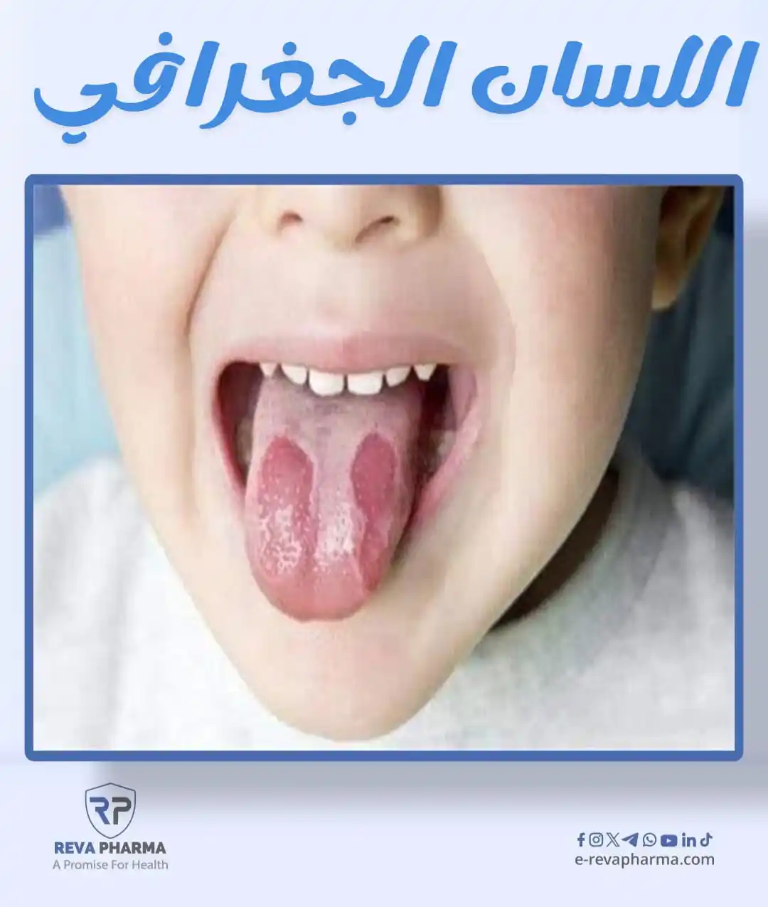 Image from Revapharma Co. ريفا فارما للصناعات الدوائية: لسان طفلك فيه بقع غريبة؟ 👅 هل لاحظت تغيّر شكل سطح اللسان وظهور مناط...