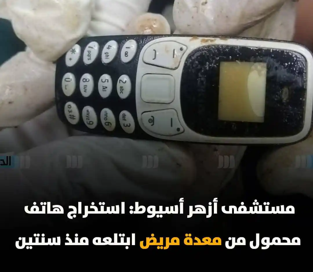 Image from شبكة الريدة الآن الإخبارية: 🔴 *مصر | في واحدة من أغرب الحالات التي ترددت على مستشفى جامعة الأزهر،...