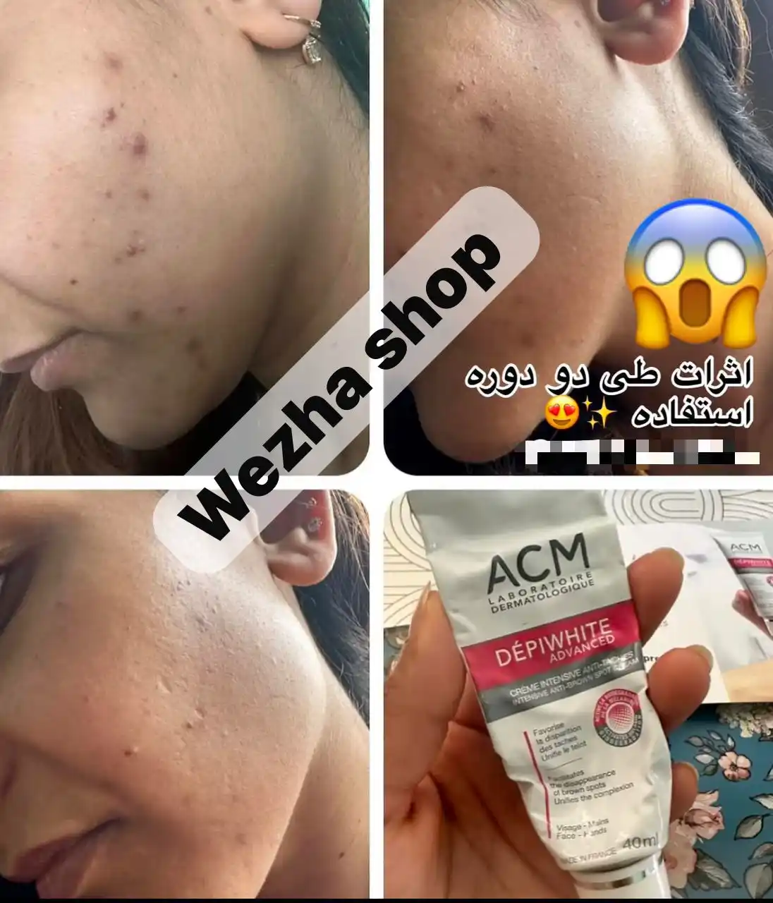 Image from فروشگاه آنلاین ویژه: 🌟 پایان لکهای صورت با کرم معروف ACM! 🎯 تاثیر مستقیم روی لکهای قدیم...
