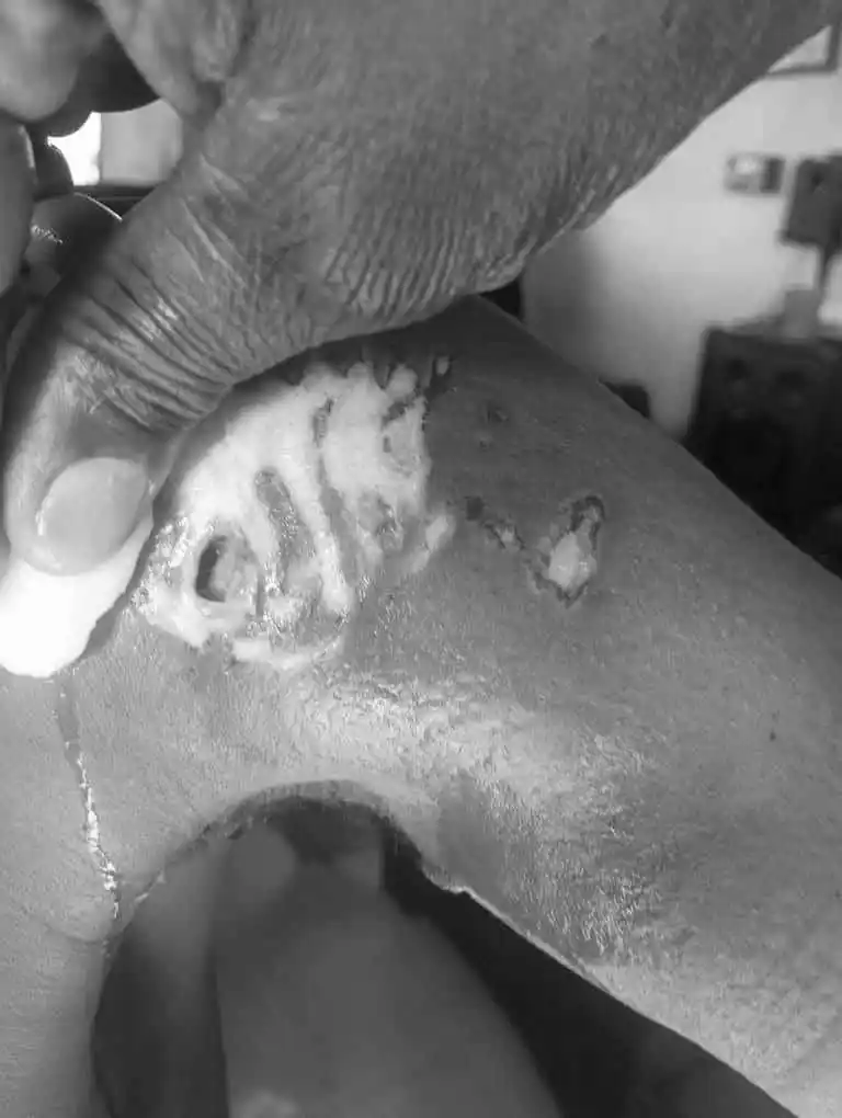 Image from THE ZIM BULLETIN NEWS: My husband was bitten by Pitbulls at the roundabout near Highglen, whe...